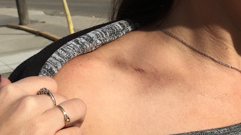 Skip the Dishes driver 'Ashley' shows her bruising after an altercation with a customer in St. Thomas, Ont., Tuesday, Oct. 20, 2020. (Brent Lale / CTV News)