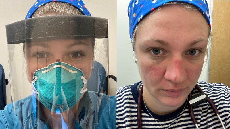 Dr. Emily Jones, a physician at the London Health Sciences Centre's University Hospital, is seen in and out over her personal protective equipment. (Source: Dr. Emily Jones)
