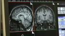 Brain scans are shown in this undated file photo.