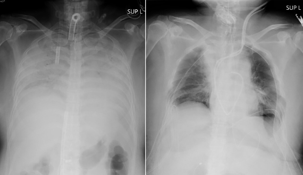Virus corona: un paciente con daño pulmonar recibe terapias alternativas de donantes vivos