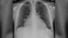 Admission chest X-ray showing an enlarged heart size in a patient who consumed four energy drinks daily for two years, resulting in hospitalization. (BMJ Case Reports)