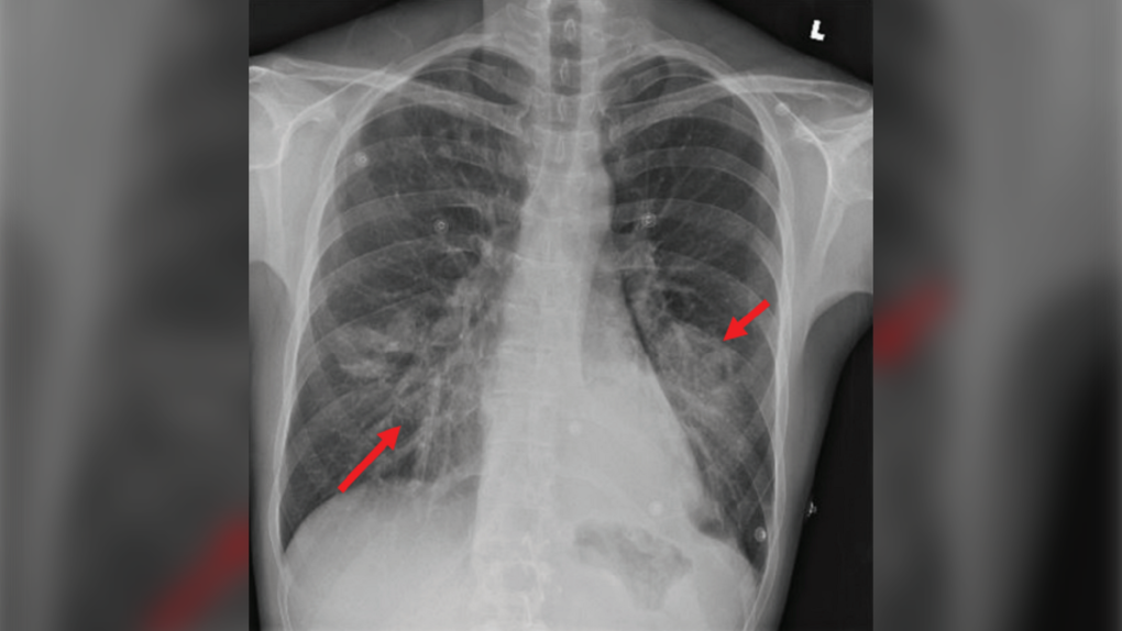 pneumonia lungs case report