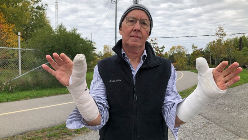 Paul Morton injured both of his arms after crashing his bike in a pothole. (Dave Charbonneau/CTV News Ottawa)