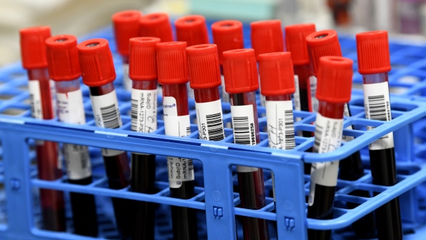 Canadian-developed screening test aims to detect early-stage cancer using blood samples