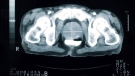 Prostate x-ray pelvis
