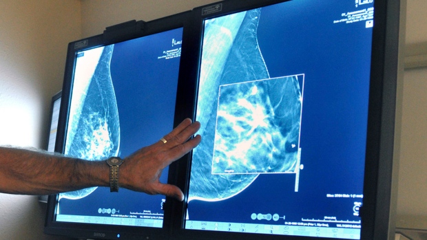Positif palsu yang umum dalam mammogram tahunan: studi
