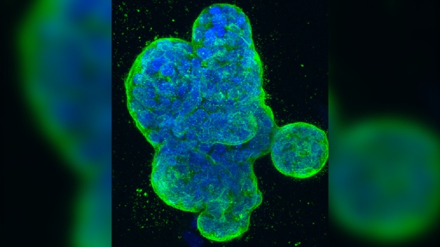 Kanker payudara: Peneliti mengidentifikasi biomarker protein