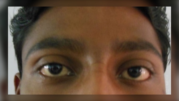 La masticazione di un uomo ha causato la formazione di una ciste dietro l’occhio: un caso clinico