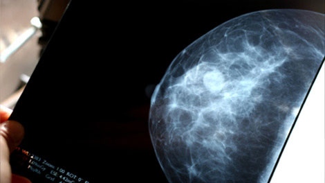 Quebec breast cancer tests