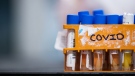 Specimens to be tested for COVID-19 are seen at a lab in Surrey, B.C., on Thursday, March 26, 2020. THE CANADIAN PRESS/Darryl Dyck