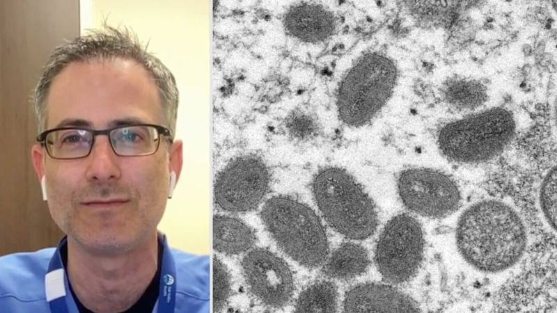 Composite photo of Dr. Allan Grill and a microscopic view of monkeypox.
