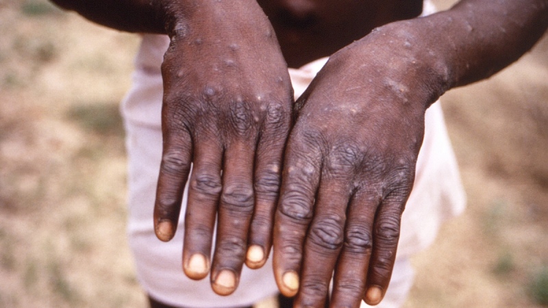This 1997 image provided by the CDC  shows a monkeypox case patient. (CDC via AP) 