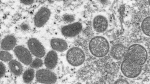 This 2003 electron microscope image made available by the Centers for Disease Control and Prevention shows mature, oval-shaped monkeypox virions, left, and spherical immature virions, right, obtained from a sample of human skin associated with the 2003 prairie dog outbreak. (Cynthia S. Goldsmith, Russell Regner/CDC via AP)