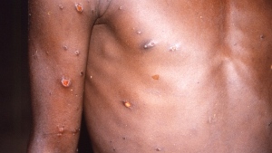 The right arm and torso of a patient whose skin displayed a number of lesions due to what had been an active case of monkeypox in 1997. (CDC via AP) 