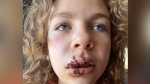 Isabella Chiasson received 16 stitches in her mouth and face after being bitten by a dog during a piano lesson. (Contributed)