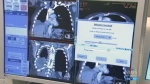  B.C. home to new lung screening program 
