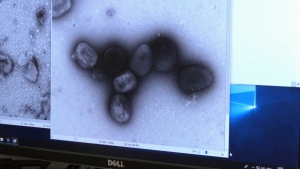 Growing monkeypox cases in Quebec