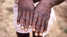 This 1997 image provided by the U.S. Centers for Disease Control and Prevention from an investigation into an outbreak of monkeypox that took place in the Democratic Republic of the Congo, formerly Zaire, depicts the dorsal surfaces of the hands of a monkeypox patient who was displaying the appearance of the characteristic rash during its recuperative stage. (CDC via AP)