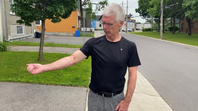 Bruce McConville shows the injuries to his arm after he was attacked by a dog (Colton Praill / CTV News Ottawa)
