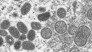 This 2003 electron microscope image made available by the Centers for Disease Control and Prevention shows mature, oval-shaped monkeypox virions, left, and spherical immature virions, right, obtained from a sample of human skin associated with the 2003 prairie dog outbreak. British health officials said Monday, June 13, 2022 they have detected another 104 cases of monkeypox in England, in what has become the biggest outbreak beyond Africa of the normally rare disease. (Cynthia S. Goldsmith, Russell Regner/CDC via AP, file)