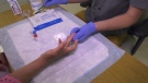 Rapid test for syphilis created