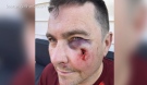 This Twitter photo provided by Peter Riley's wife, Dawn Fyn, shows the injuries he suffered after a man assaulted Riley during a bike ride on June 23, 2022. (Source: @AFNClass/Twitter)