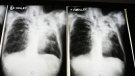 This July 30, 2009 photo shows X-rays from a tuberculosis patient at A. G. Holley Hospital in Lantana, Fla.  (AP Photo/Lynne Sladky)