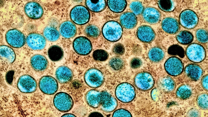 A colourized transmission electron micrograph of monkeypox particles (teal) found within an infected cell (brown), is shown in a handout photo captured at the NIAID Integrated Research Facility (IRF) in Fort Detrick, Maryland. THE CANADIAN PRESS/HO-National Institute of Allergy and Infectious Diseases.