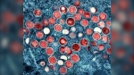 This image provided by the National Institute of Allergy and Infectious Diseases (NIAID) shows a colorized transmission electron micrograph of monkeypox particles (red) found within an infected cell (blue). (NIAID via AP)
