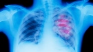 Seen here is an illustration of an X-ray depicting lung cancer. A new study shows that nearly half of deaths due to cancer can be attributable to preventable risk factors. (Peter Dazeley/The Image Bank RF/Getty Images/CNN)