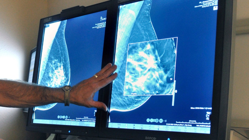 In this file photo, a radiologist compares an image from earlier, 2-D technology mammogram to the new 3-D Digital Breast Tomosynthesis mammography in Wichita Falls, Texas. (Torin Halsey/Times Record News via AP, File) 