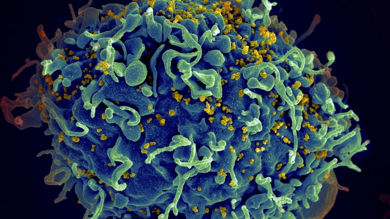 FILE - This electron microscope image made available by the U.S. National Institutes of Health shows a human T cell, in blue, under attack by HIV, in yellow, the virus that causes AIDS. (Seth Pincus, Elizabeth Fischer, Austin Athman/National Institute of Allergy and Infectious Diseases/NIH via AP) 