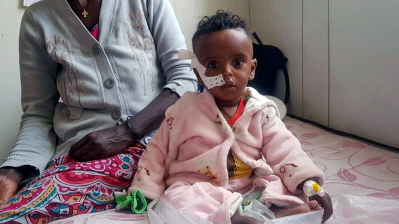 Yordanos Mebrahtiu, 1, is treated for malnutrition at the Ayder Referral Hospital in Mekele, in the Tigray region of northern Ethiopia, Oct. 4, 2022. (AP Photo)