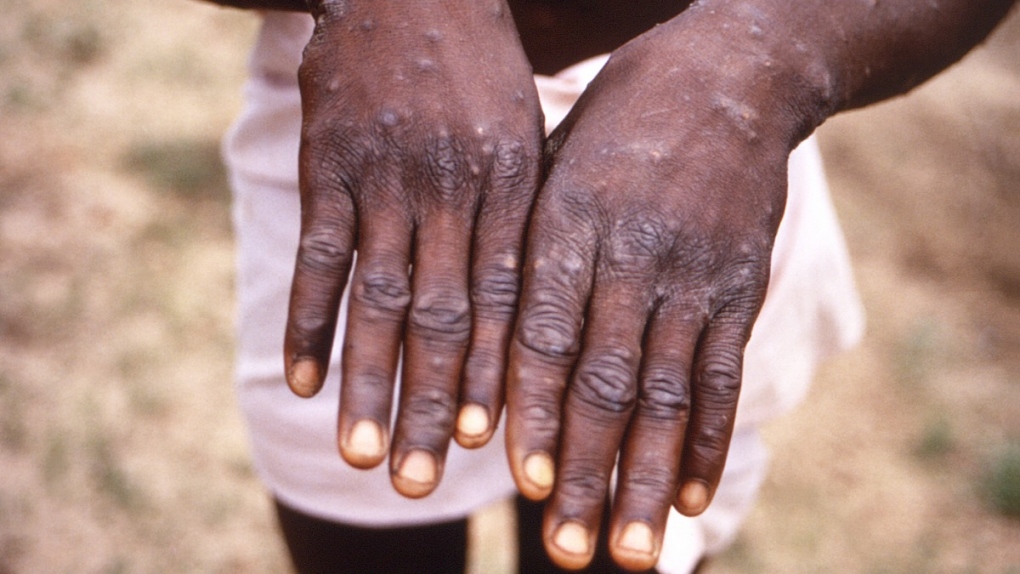 The hands of a monkeypox patient in 1997