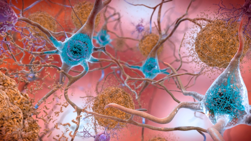 This illustration made available by the National Institute on Aging/National Institutes of Health depicts cells in an Alzheimer`s affected brain, with abnormal levels of the beta-amyloid protein clumping together to form plaques, brown, that collect between neurons and disrupt cell function. (National Institute on Aging, NIH via AP)