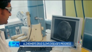 Study examines Alzheimer’s drug 