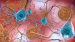 This illustration made available by the National Institute on Aging/National Institutes of Health depicts cells in an Alzheimer's affected brain, with abnormal levels of the beta-amyloid protein clumping together to form plaques, brown, that collect between neurons and disrupt cell function. (National Institute on Aging, NIH via AP) 