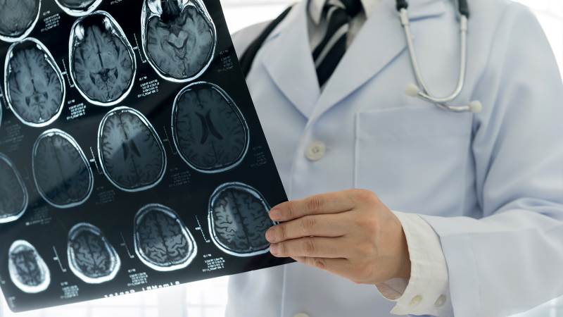 A doctor looks at brain scans of a patient's brain in this stock image. (Source: Getty Images)