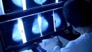 Study on heightened breast cancer risk