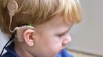 Cytomegalovirus is the most common cause of non-hereditary hearing loss in children. (Source: CMV Canada)