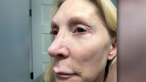 An image of Tracey Hassell after her cosmetic eye procedure. (Courtesy of Tracey Hassell)