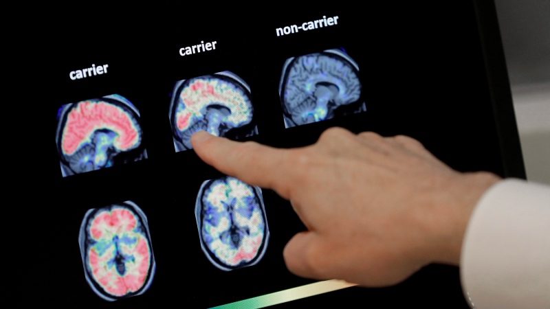 Dr. William Burke goes over a PET brain scan Tuesday, Aug. 14, 2018 at Banner Alzheimers Institute in Phoenix. (AP Photo/Matt York)