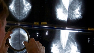A radiologist uses a magnifying glass to check mammograms for breast cancer in Los Angeles, May 6, 2010. THE CANADIAN PRESS/AP/Damian Dovarganes