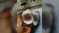 It took over 50 stitches to close the wound on the boy’s scalp, the parents said. The nurse told his father that it was centimetres away from puncturing the skull. 