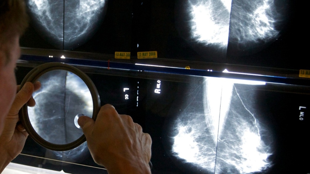 A radiologist inspects a mammogram in 2010