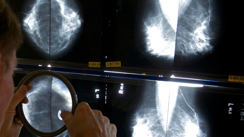 A radiologist uses a magnifying glass to check mammograms for breast cancer in Los Angeles, May 6, 2010. A health authority in central Newfoundland says it's reviewing mammograms for approximately 3,000 patients after discovering some images had been analyzed using incorrect screens.THE CANADIAN PRESS/AP-Damian Dovarganes 