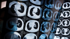In this Thursday, Dec. 8, 2016 photo, CT scans of lung cancer patients at the Jingdong Zhongmei private hospital in Yanjiao, China's Hebei Province. (AP Photo/Andy Wong)