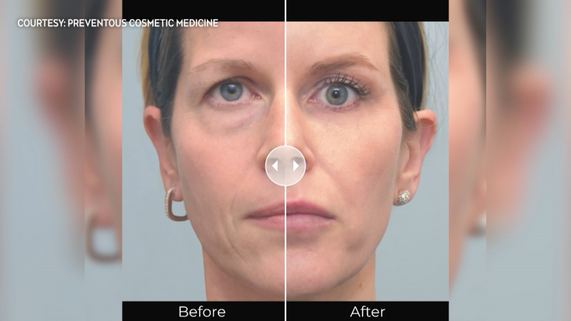 SPONSORED: Learn more about the difference between neuromodulators and dermal fillers with the team at Preventous Cosmetic Medicine