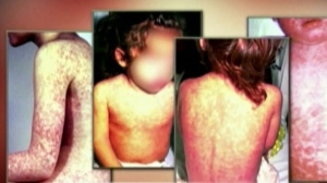 Case of measles prompts alert