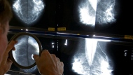 A radiologist uses a magnifying glass to check mammograms for breast cancer in Los Angeles. THE CANADIAN PRESS/AP-Damian Dovarganes 